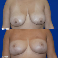 FMPS B & A  - breast reduction