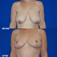 FMPS B & A - breast reduction