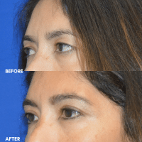 OLD FMPS B&A Template- Sanderson & Braswell Patients - 2025-11-24-upperbleph-01 (2)