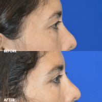 OLD FMPS B&A Template- Sanderson & Braswell Patients - 2025-11-24-upperbleph-01 (3)