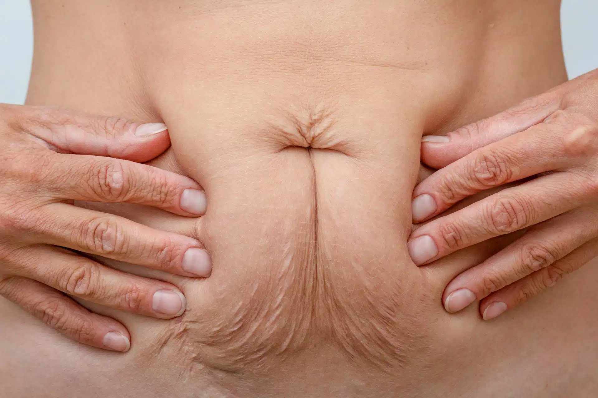 Loose Skin After Weight Loss